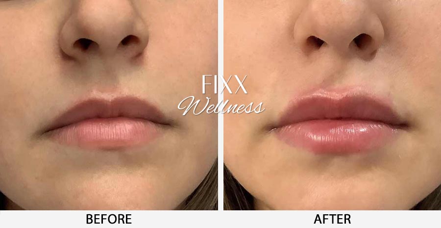 Lip filler treatment in South Miami