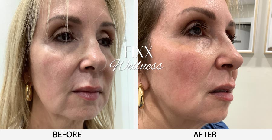 Combination treatment of Sculptra & Morpheus for a female patient in South Miami