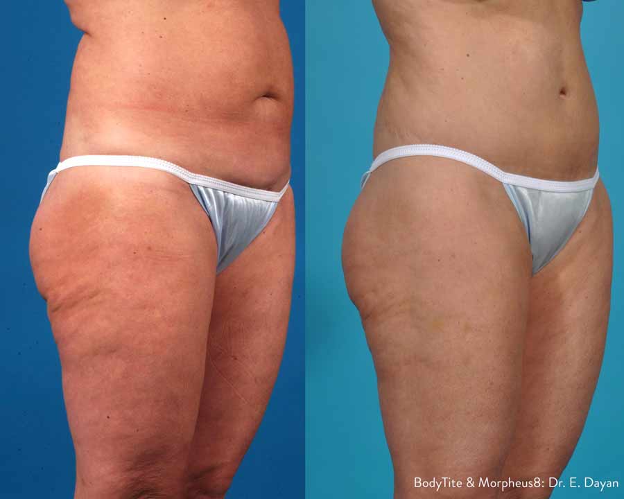 Body Tite Morpheus8 Dr. Dayan