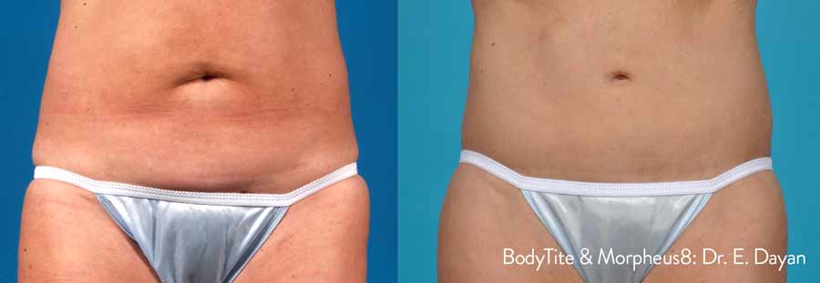 Body Tite Morpheus8 Dr. Dayan