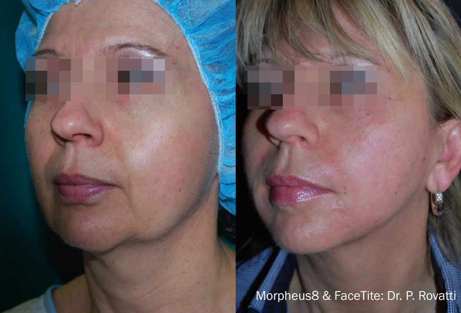 Face Tite Morpheus8 Dr. Rovatti